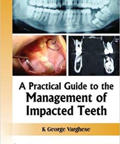 A Practical Guide to the Management of Impacted Teeth