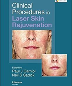 Clinical Procedures in Laser Skin Rejuvenation