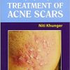 Step by Step Treatment of Acne Scars