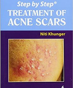 Step by Step Treatment of Acne Scars