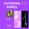 Carcinoma of the Kidney