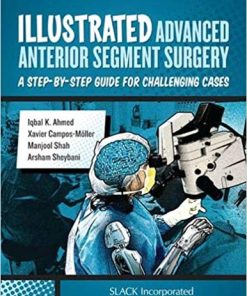 Illustrated Advanced Anterior Segment Surgery A Step-by Step Guide for Challenging Cases