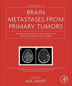 Brain Metastases from Primary Tumors Volume 3 Epidemiology Biology and Therapy of Melanoma and Other Cancers