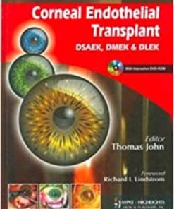 Corneal Endothelial Transplant