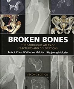 Broken Bones The Radiologic Atlas of Fractures and Dislocations 2nd Edition