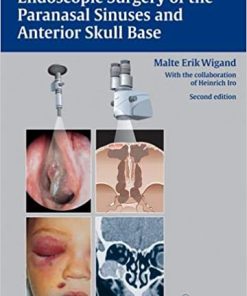 Endoscopic Surgery of the Paranasal Sinuses and Anterior Skull Base
