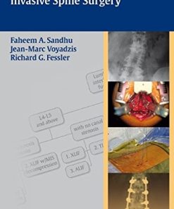 Decision Making for Minimally Invasive Spine Surgery