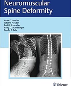 Neuromuscular Spine Deformity
